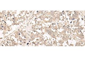 Immunohistochemistry of paraffin-embedded Human lung cancer tissue using RRP1 Polyclonal Antibody at dilution of 1:45(x200) (RRP1 抗体)