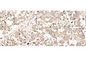 Immunohistochemistry of paraffin-embedded Human lung cancer tissue using RRP1 Polyclonal Antibody at dilution of 1:45(x200) (RRP1 抗体)