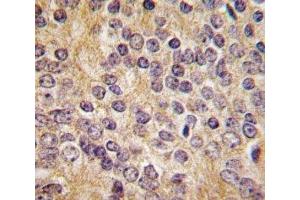 IHC analysis of FFPE human prostate carcinoma tissue stained with UPA antibody (PLAU 抗体  (AA 396-426))