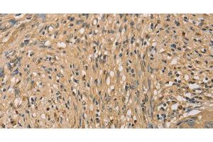 Immunohistochemistry of paraffin-embedded Human cervical cancer tissue using SETD2 Polyclonal Antibody at dilution 1:40 (SETD2 抗体)