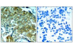 Immunohistochemical analysis of paraffin-embedded human breast carcinoma tissue, using (EGFR 抗体  (pTyr1172))
