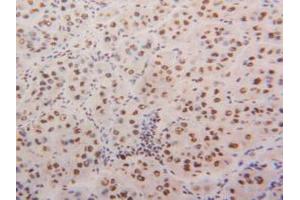 IHC-P analysis of Human Liver Cancer Tissue, with DAB staining. (HNRNPA2B1 抗体  (AA 21-103))