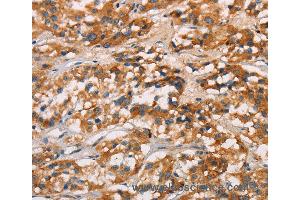 Immunohistochemistry of Human gastric cancer using CD80 Polyclonal Antibody at dilution of 1:50 (CD80 抗体)