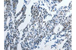 The image on the left is immunohistochemistry of paraffin-embedded Human gastric cancer tissue using ABIN7191895(PIWIL3 Antibody) at dilution 1/20, on the right is treated with synthetic peptide. (PIWIL3 抗体)