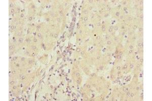 Immunohistochemistry of paraffin-embedded human liver cancer using ABIN7146746 at dilution of 1:100 (CBR4 抗体  (AA 1-237))
