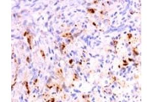 Formalin-fixed, paraffin-embedded human polyostotic sclerosing histiocytosis (Erdheim Chester disease) stained with anti-TNF alpha antibody (SPM543). (TNF alpha 抗体  (AA 115-130))