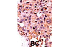 Formalin-fixed and paraffin-embedded human cancer tissue reacted with PPP3CA polyclonal antibody  , which was peroxidase-conjugated to the secondary antibody, followed by AEC staining. (PPP3CA 抗体  (N-Term))