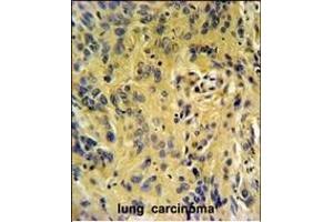 TESC Antibody (C-term) (ABIN651329 and ABIN2840191) IHC analysis in formalin fixed and paraffin embedded human lung carcinoma followed by peroxidase conjugation of the secondary antibody and DAB staining. (Tescalcin 抗体  (C-Term))