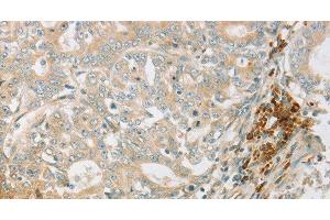 Immunohistochemistry of paraffin-embedded Human gastric cancer tissue using AMPK alpha1 Polyclonal Antibody at dilution 1:70 (PRKAA1 抗体)