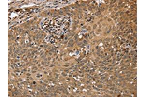 The image on the left is immunohistochemistry of paraffin-embedded Human cervical cancer tissue using ABIN7191664(NMT1 Antibody) at dilution 1/45, on the right is treated with synthetic peptide. (NMT1 抗体)