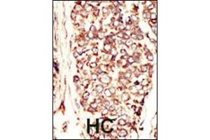 Formalin-fixed and paraffin-embedded human cancer tissue reacted with the primary antibody, which was peroxidase-conjugated to the secondary antibody, followed by AEC staining. (ErbB2/Her2 抗体  (N-Term))