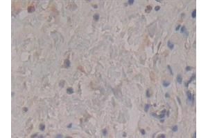 Detection of Rock2 in Human Stomach cancer Tissue using Polyclonal Antibody to Rho Associated Coiled Coil Containing Protein Kinase 2 (Rock2) (ROCK2 抗体  (AA 904-1140))