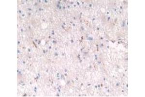 Detection of LRP4 in Human Glioma Tissue using Polyclonal Antibody to Low Density Lipoprotein Receptor Related Protein 4 (LRP4) (LRP4 抗体  (AA 1610-1885))