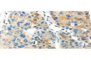Immunohistochemistry of paraffin-embedded Human liver cancer using PDPN Polyclonal Antibody at dilution of 1/20 (Podoplanin 抗体)
