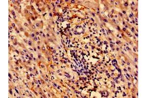 Immunohistochemistry of paraffin-embedded human liver cancer using ABIN7176118 at dilution of 1:100