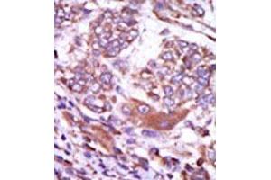 Formalin-fixed and paraffin-embedded human cancer tissue (hepatocarcinoma) reacted with the primary antibody, which was peroxidase-conjugated to the secondary antibody, followed by AEC staining. (CAMK2D 抗体  (C-Term))