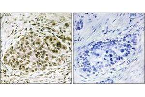 Immunohistochemistry analysis of paraffin-embedded human lung carcinoma tissue, using Lyl-1 Antibody. (LYL1 抗体  (AA 151-200))