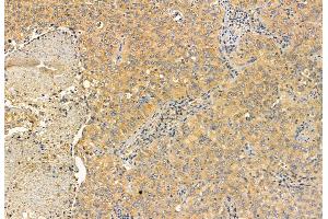ABIN6263341 and ABIN6272902 at 1/100 staining Human lung cancer by IHC-P.
