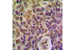 Immunohistochemical analysis of BRMS1 staining in human breast cancer formalin fixed paraffin embedded tissue section. (BRMS1 抗体  (Center))