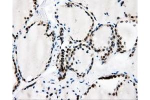 Immunohistochemical staining of paraffin-embedded Adenocarcinoma of breast tissue using anti-CAMK1D mouse monoclonal antibody. (CAMK1D 抗体)