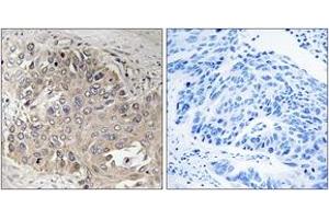 Immunohistochemistry analysis of paraffin-embedded human lung carcinoma, using SPTBN5 Antibody. (SPTbN5 抗体  (AA 481-530))