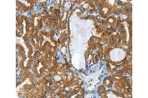 Immunohistochemistry of Human liver cancer using CLPTM1L Polyclonal Antibody at dilution of 1:60 (CLPTM1L 抗体)
