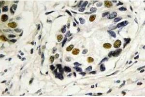 Immunohistochemistry (IHC) analyzes of p53 antibody in paraffin-embedded human breast carcinoma tissue. (p53 抗体)