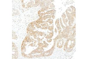 Immunohistochemistry (IHC) image for anti-Metadherin (MTDH) (AA 475-525) antibody (ABIN7795651) (Recombinant MTDH 抗体  (AA 475-525))