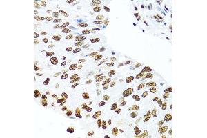 Immunohistochemistry of paraffin-embedded human prostate cancer using SSB antibody at dilution of 1:100 (40x lens). (SSB 抗体)