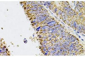 Immunohistochemistry of paraffin-embedded Human colon carcinoma using ALDH1A1 Polyclonal Antibody at dilution of 1:100 (40x lens). (ALDH1A1 抗体)