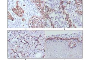 Immunohistochemical analysis of paraffin-embedded human lung cancer (A), endometrial carcinoma (B), sublingual gland (C) and esophagus (D) tissues using CK17 mouse mAb with DAB staining. (KRT17 抗体)