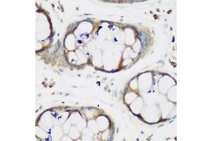 Immunohistochemistry of paraffin-embedded human gastric using MTDH antibody (ABIN5975399) at dilution of 1/200 (40x lens). (MTDH 抗体)