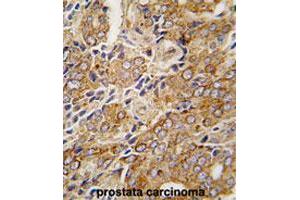 Formalin-fixed and paraffin-embedded human prostate carcinomareacted with TRPM8 polyclonal antibody , which was peroxidase-conjugated to the secondary antibody, followed by AEC staining. (TRPM8 抗体  (AA 933-963))