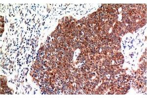 Immunohistochemistry of paraffin-embedded Human breast carcinoma tissue using BECN1 Monoclonal Antibody at dilution of 1:200. (Beclin 1 抗体)