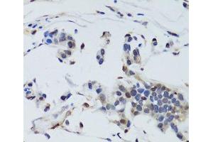 Immunohistochemistry of paraffin-embedded Human gastric cancer using DNMT1 Polyclonal Antibody at dilution of 1:200 (40x lens). (DNMT1 抗体)