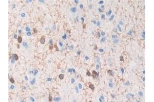 Detection of TPPP in Human Glioma Tissue using Polyclonal Antibody to Tubulin Polymerization Promoting Protein (TPPP) (Tppp 抗体  (AA 8-210))