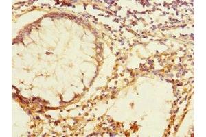 Immunohistochemistry of paraffin-embedded human colon cancer using ABIN7171814 at dilution of 1:100 (TEX43 抗体  (AA 1-134))