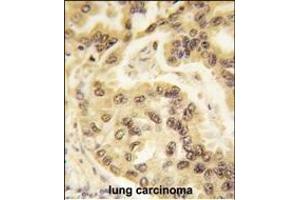 Formalin-fixed and paraffin-embedded human lung carcinoma tissue reacted with p53 Antibody  h , which was peroxidase-conjugated to the secondary antibody, followed by DAB staining. (p53 抗体  (AA 293-322))