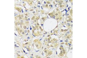 Immunohistochemistry of paraffin-embedded human breast cancer using  antibody (ABIN1678593, ABIN3018971, ABIN3018972 and ABIN6220651) at dilution of 1:100 (40x lens). (ADRM1 抗体  (AA 108-407))