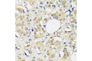 Immunohistochemistry of paraffin-embedded human breast cancer using  antibody (ABIN1678593, ABIN3018971, ABIN3018972 and ABIN6220651) at dilution of 1:100 (40x lens). (ADRM1 抗体  (AA 108-407))