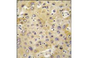 Formalin-fixed and paraffin-embedded human hepatocarcinoma tissue reacted with PPBP antibody (C-term), which was peroxidase-conjugated to the secondary antibody, followed by DAB staining. (CXCL7 抗体  (C-Term))