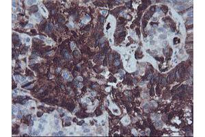 Immunohistochemical staining of paraffin-embedded Adenocarcinoma of Human ovary tissue using anti-AHSG mouse monoclonal antibody. (Fetuin A 抗体)