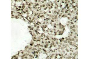Immunohistochemistry of paraffin-embedded human breast carcinoma tissue, using Phospho-STAT1-S727 antibody (ABIN2988310). (STAT1 抗体  (pSer727))
