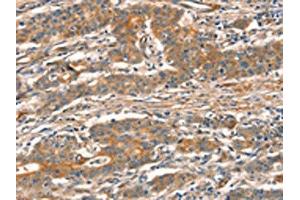 The image on the left is immunohistochemistry of paraffin-embedded Human gastic cancer tissue using ABIN7129096(CUEDC2 Antibody) at dilution 1/30, on the right is treated with fusion protein. (CUEDC2 抗体)