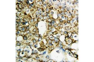 Anti-TFPI2 antibody, IHC(P) IHC(P): Human Mammary Cancer Tissue