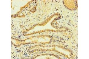 Immunohistochemistry of paraffin-embedded human prostate cancer using ABIN7155180 at dilution of 1:100 (Fc epsilon RI/FCER1A 抗体  (AA 26-205))