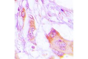 Immunohistochemical analysis of MARK staining in human lung cancer formalin fixed paraffin embedded tissue section. (MARK1 抗体  (Center))