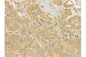 ABIN6263086 and ABIN6277126 at 1/100 staining human lung adenocarcinoma by IHC-P. (MALT1 抗体  (Internal Region))