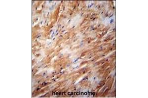 TFB2M Antibody (C-term) (ABIN654104 and ABIN2843988) immunohistochemistry analysis in formalin fixed and paraffin embedded human heart carcinoma followed by peroxidase conjugation of the secondary antibody and DAB staining.