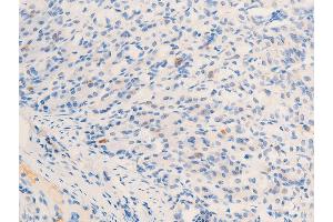 Immunohistochemistry (IHC) image for anti-Receptor tyrosine-protein kinase erbB-2 (ErbB2/Her2) (pTyr877) antibody (ABIN6256054)